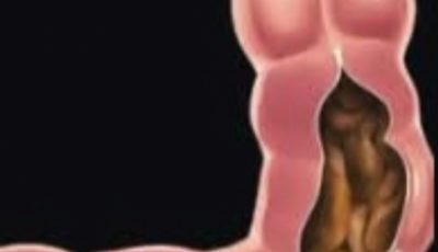 Drink Just 1 Glasses and Cleanse Your Entire Colon in 10 Minutes! Can’t Poop? This Morning Drink Will Clear You Out Fast