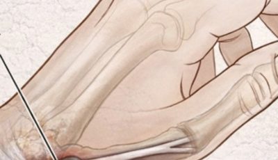 Why Do Your Hands Fall Asleep? Common Causes and Natural Remedies That Actually Work