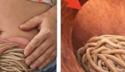 Garlic eliminates parasites in just 1 day? What you really should know before trying it